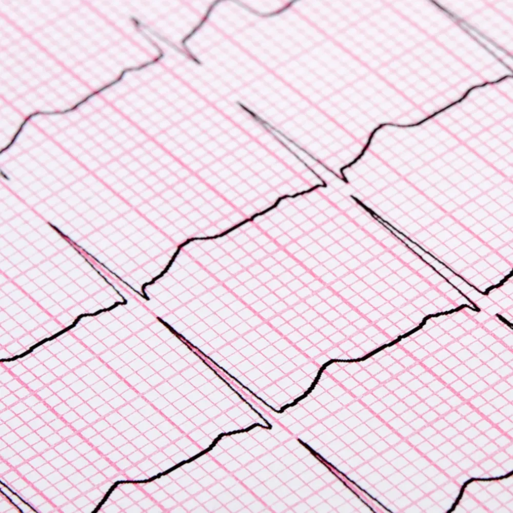 EKG rhythm strip