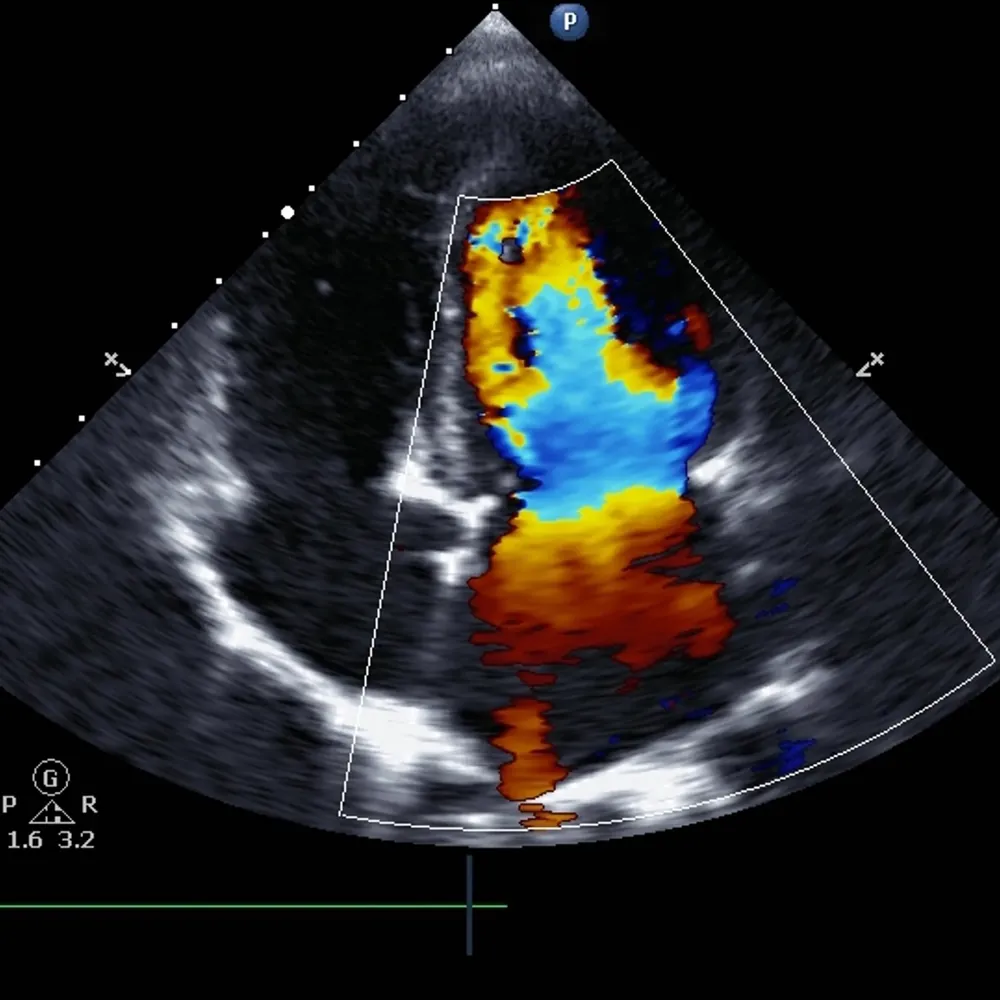 Transesophageal echocardiogram